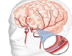 Recuperare dopo un Ictus: quanto è possibile?