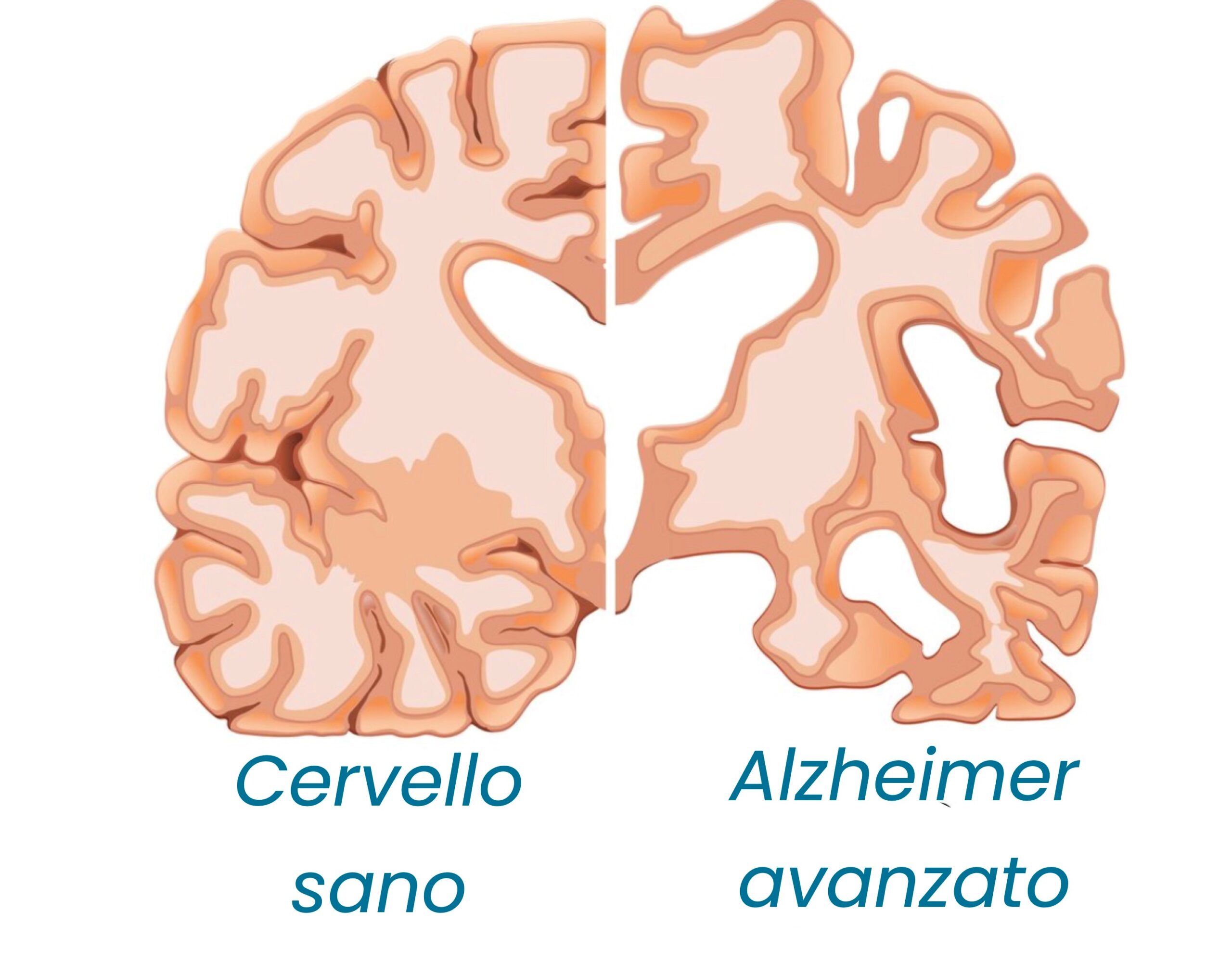 Giornata mondiale dell’Alzheimer: la diagnosi precoce può fare la differenza